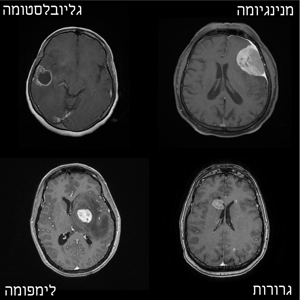 סריקות MRI של גידולי מוח