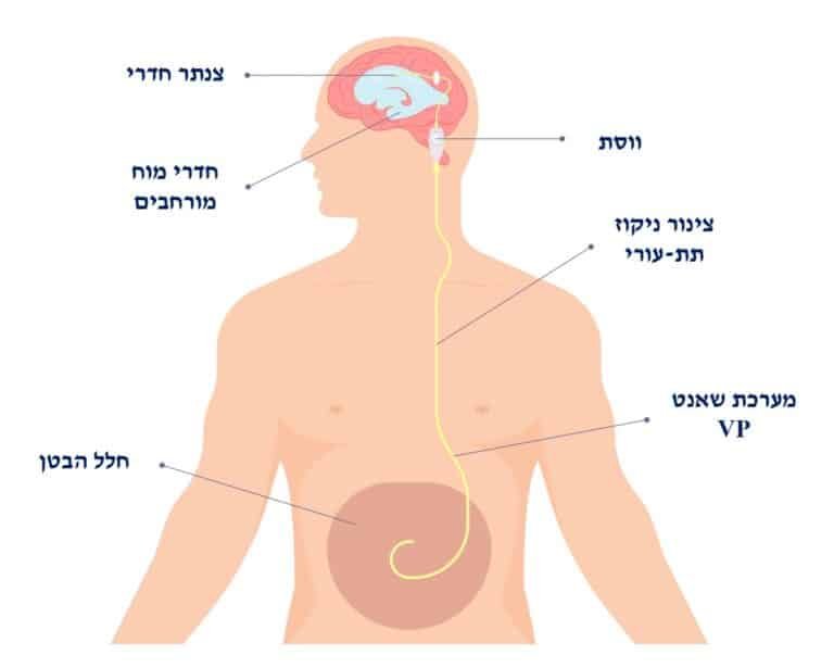 תיאור סכמתי של מערכת דלף (שאנט) מסוג VP